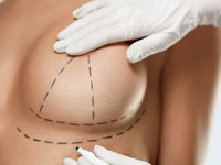 Можно ли исправить птоз груди без следов от операции? Как работает подтяжка и какие есть альтернативы