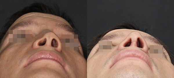 Восстановление носа после перелома, вид снизу, хирург Григорянц В.С.