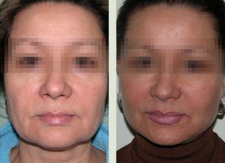 Подтяжка лица: фото до и после