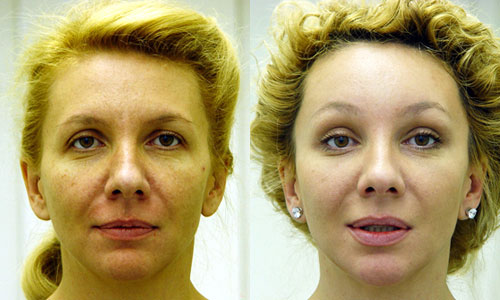 Подтяжка лица фото до и после