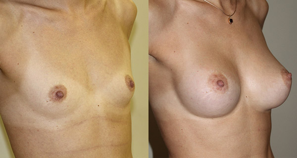 увеличение груди, фото до и после операции