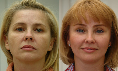 Тотальный лифтинг лица, фото до и после, хирург В.Г. Якимец