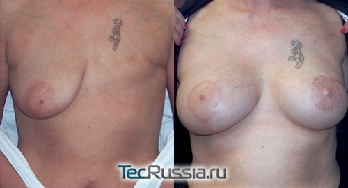 результат восстановитедьной пластики груди после мастэктомии