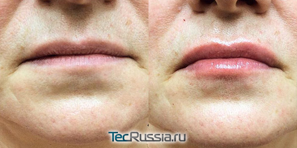 HAfiller для увеличения губ – фото до и после