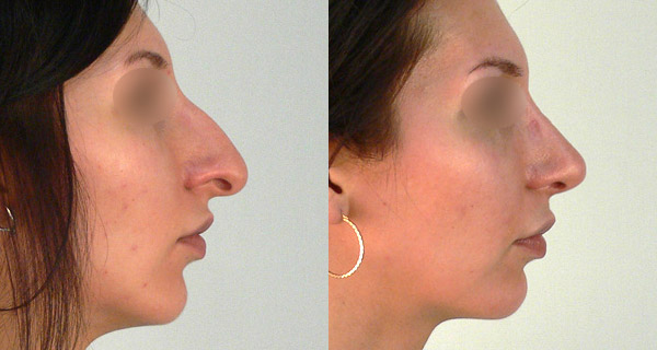 Пластика носа: фото до и после операции