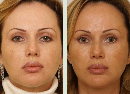 Подтяжка лица: фото до и после