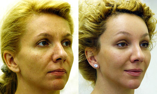 Подтяжка верхней трети лица фото до и после