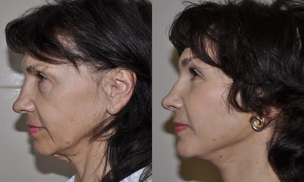 Фото до и после подтяжки лица, хирург Шиъирман Э.В.