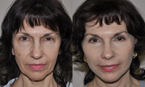Фото до и после комплексного лифтинга лица