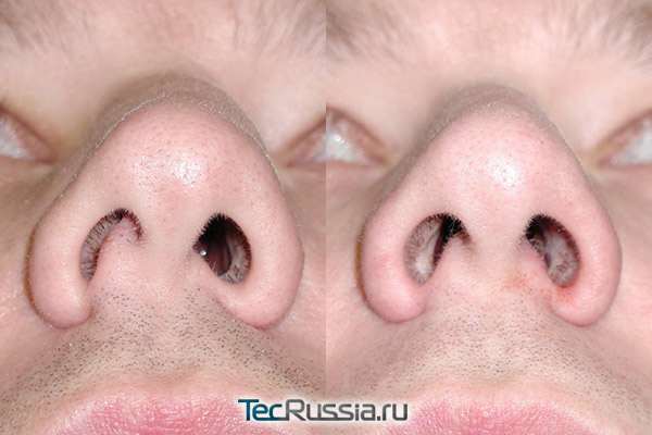 Операция при искривлении носовой перегородки