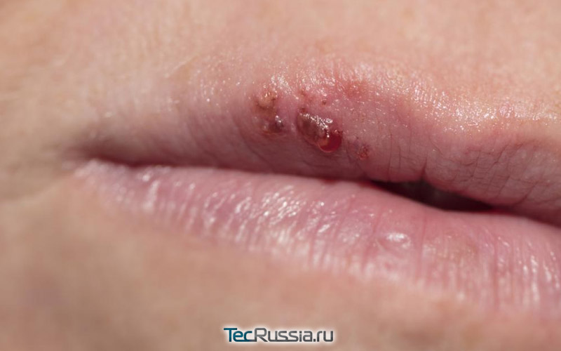 Ошибки пациентов при увеличении губ филлером