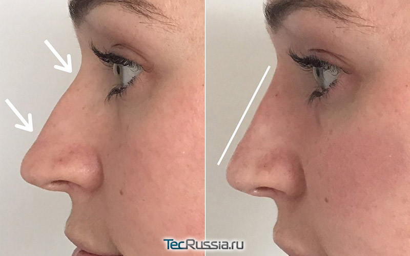 Нос гиалуроновой кислотой фото до и после