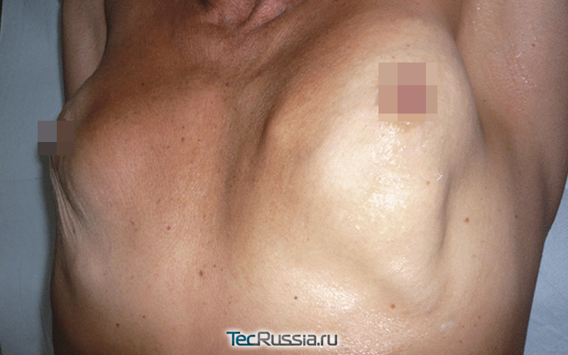 Реабилитация после маммопластики (пластики груди)