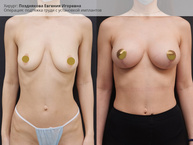 Фото до и после подтяжкт груди с установкой имплантов, хирург Е.Позднякова